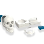 protese-craniana-cranioplastia-1 protese-craniana-cranioplastia-1